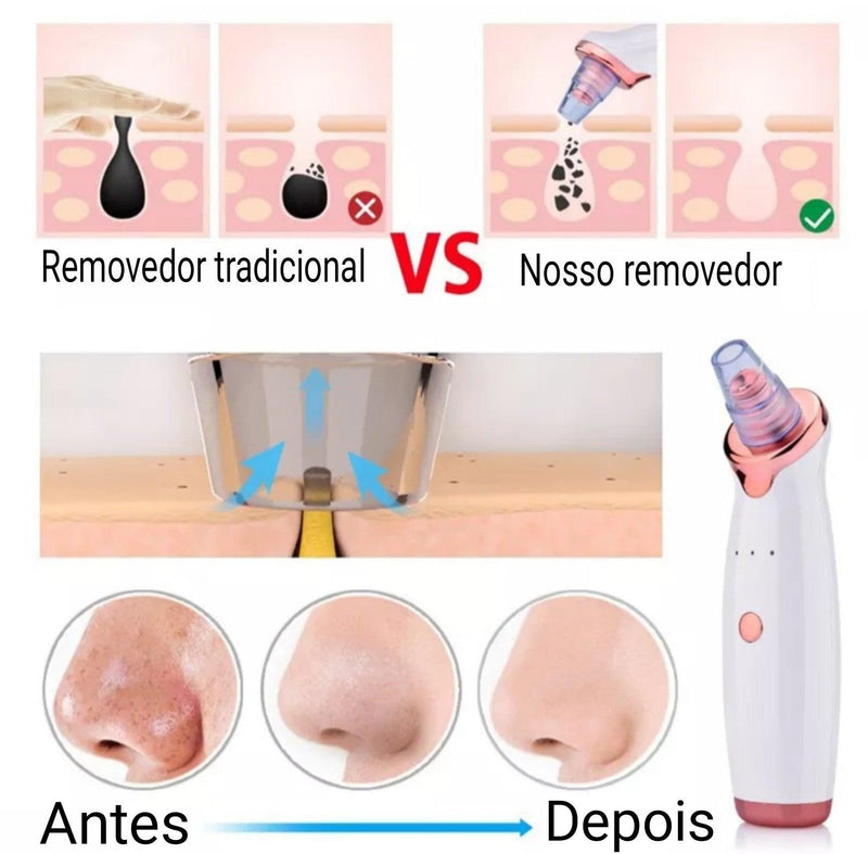 Removedor de Cravos e Espinhas à vácuo - Clear Skin